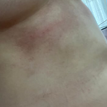 Krem Kullanımı Sonrası Morarma Ve Yanma Sorunu