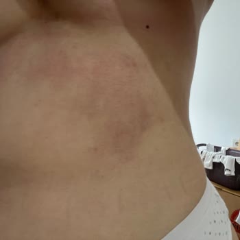 Krem Kullanımı Sonrası Morarma Ve Yanma Sorunu