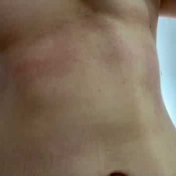 Krem Kullanımı Sonrası Morarma Ve Yanma Sorunu