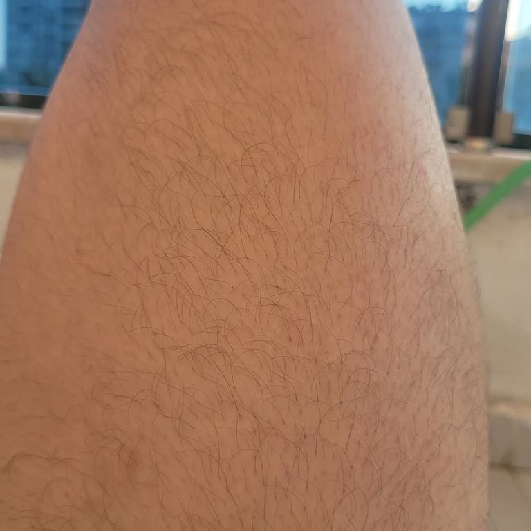 Lazer İşlem Sonrası Sonuçsuz Hizmet Ve İlgisiz Yaklaşım Mağduriyet Yarattı