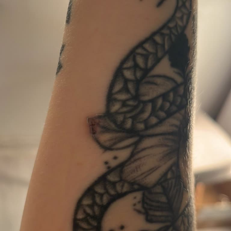 Aymira Koçaklı Yaşam Merkezi Lazer İşleminde Dikkatsizlik Ve Yanık Problemi