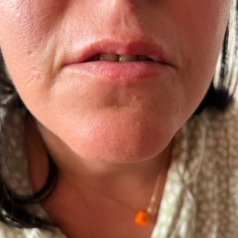 NG Pluss Güzellik Merkezi Dudak Dolgusu Yamukluğu