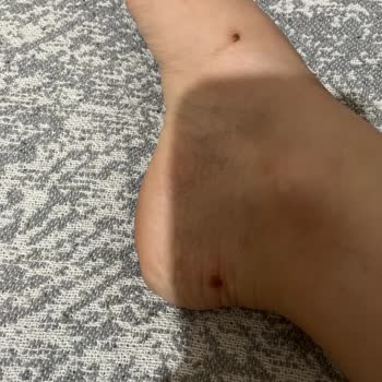 Ayakkabı Kaynaklı Yaralanma Ve Satış Sorumlusunun Olumsuz Tavrı