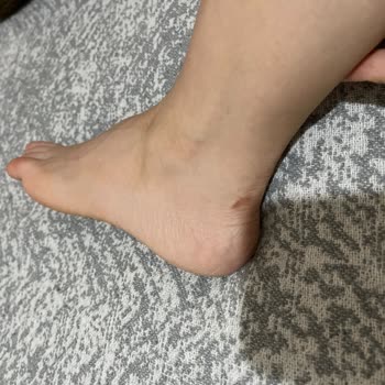 Ayakkabı Kaynaklı Yaralanma Ve Satış Sorumlusunun Olumsuz Tavrı