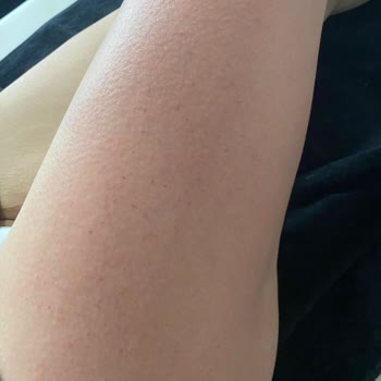 Yanlış Uygulama Sonucu Sağlık Sorunları Ve İade Sorunu Yaşadım