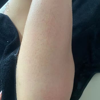 Yanlış Uygulama Sonucu Sağlık Sorunları Ve İade Sorunu Yaşadım