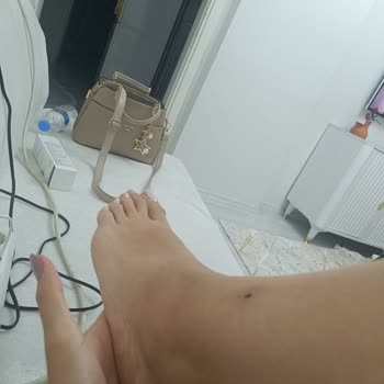 Yanlış Uygulama Sonucu Sağlık Sorunları Ve İade Sorunu Yaşadım