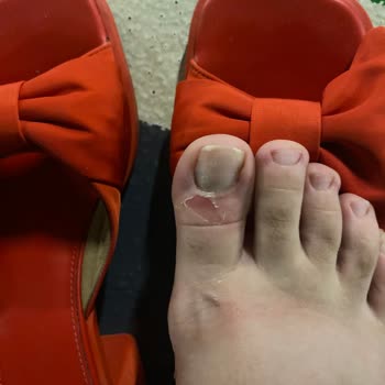 Aldığım Terlik Ayağımı Yaraladı, Mağazadan Destek Alamıyorum