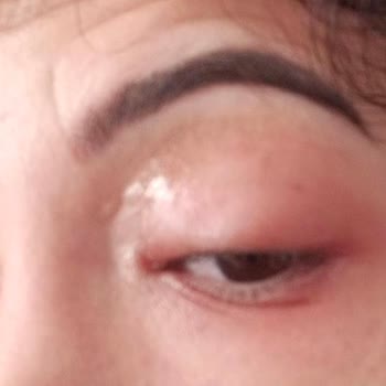 FullFresh Göz Damlası Sonrası Şişlik Ve Yan Etki Şikayeti