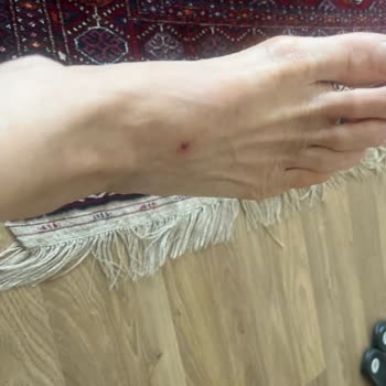 Aldığım Terlik Ayağımı Yaraladı, Çözüm İçin Yaz Sonunu Beklemem İsteniyor!