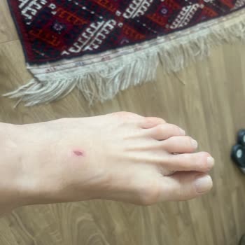 Aldığım Terlik Ayağımı Yaraladı, Çözüm İçin Yaz Sonunu Beklemem İsteniyor!