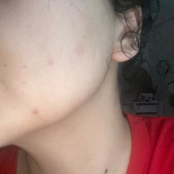 Caudalie Stick Güneş Kremi Cildimde Ciddi Sivilce Ve Komedonlara Neden Oldu