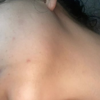 Caudalie Stick Güneş Kremi Cildimde Ciddi Sivilce Ve Komedonlara Neden Oldu