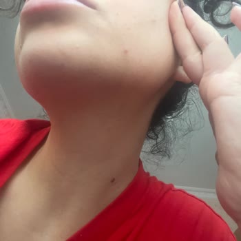 Caudalie Stick Güneş Kremi Cildimde Ciddi Sivilce Ve Komedonlara Neden Oldu