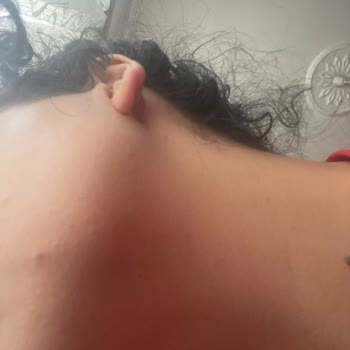 Caudalie Stick Güneş Kremi Cildimde Ciddi Sivilce Ve Komedonlara Neden Oldu