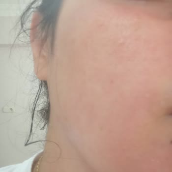 Hassas Ciltler İçin Üretilen Yüz Temizleme Köpüğü Cildimi Yaktı