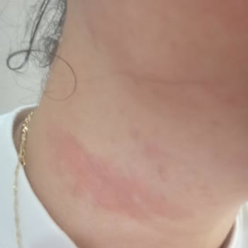 Hassas Ciltler İçin Üretilen Yüz Temizleme Köpüğü Cildimi Yaktı