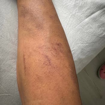 Lazer Seanslarında Tekrarlayan Yanıklar Sonunda Pes Ettim