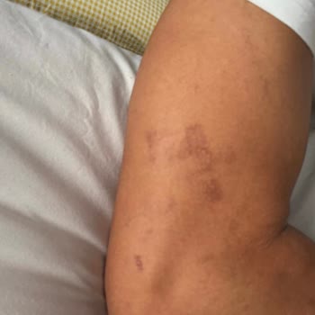 Lazer Seanslarında Tekrarlayan Yanıklar Sonunda Pes Ettim