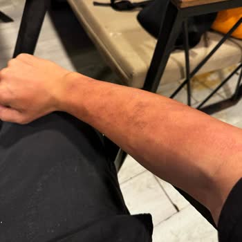 Lazer Seanslarında Tekrarlayan Yanıklar Sonunda Pes Ettim