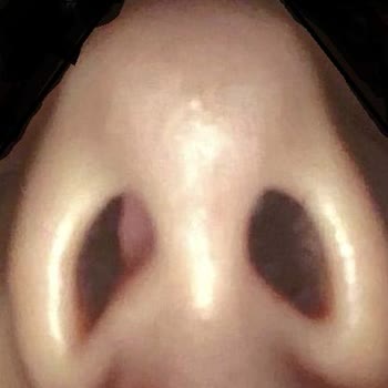 Doç. Dr. Yahya Baltu Burun Ameliyatı Sonrası Kalıcı Nefes Alma Problemleri Ve Yetersiz Doktor İlgisi