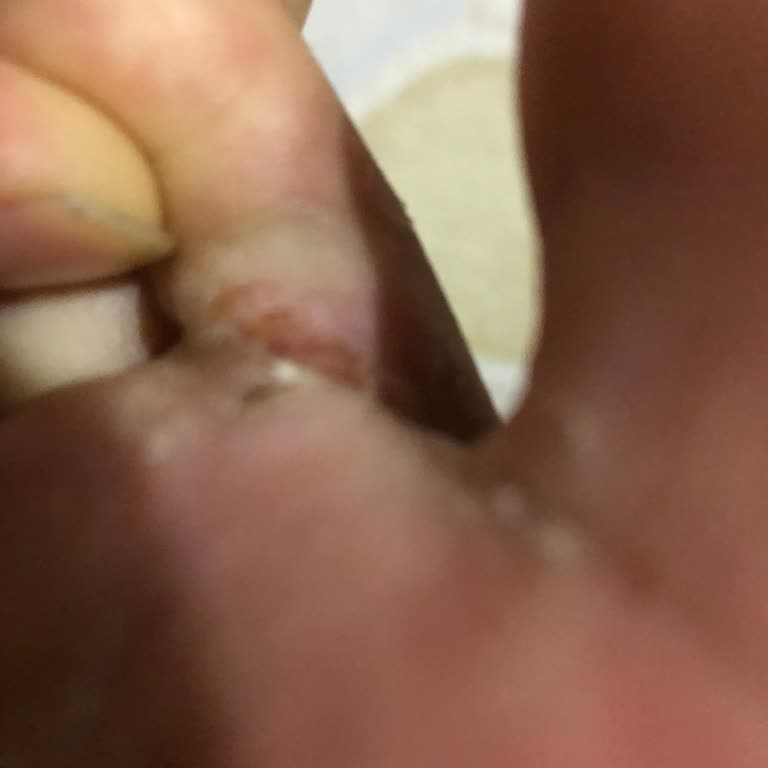 Yeni Alınan Ayakkabı Yaraya Sebep Oldu, İade Ve Değişim Yapılmadı