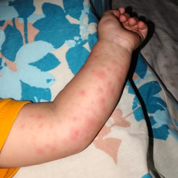 Bebek Losyonu Sonrası Ciltte Kabarma Ve Kızarıklık Yaşadık, Acil Çözüm Bekliyorum