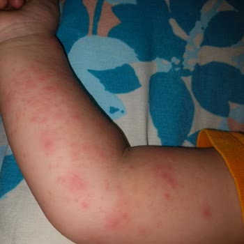 Bebek Losyonu Sonrası Ciltte Kabarma Ve Kızarıklık Yaşadık, Acil Çözüm Bekliyorum