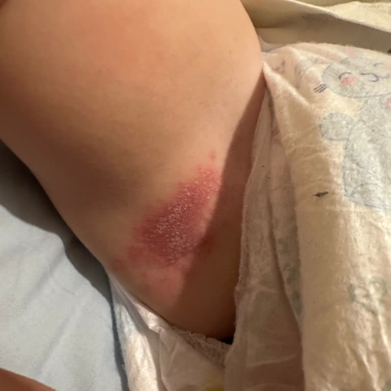 Molfix Bebek Bezi Pişik Ve Mantara Sebep Oldu, Mağduriyetim Giderilsin