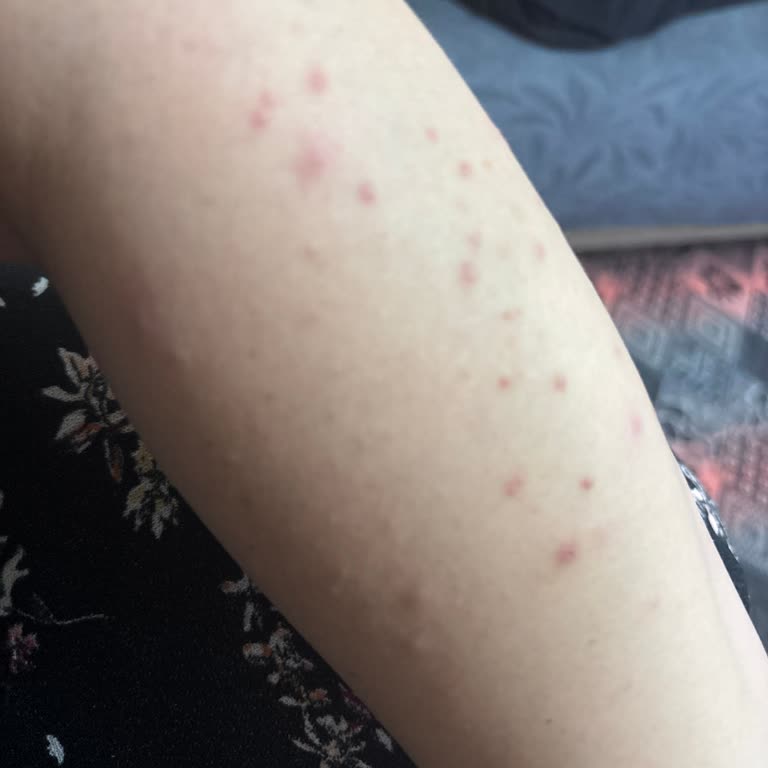 Eksik Ürün Teslimatı Ve Ciltte Tahriş Sorunu Yaşadım