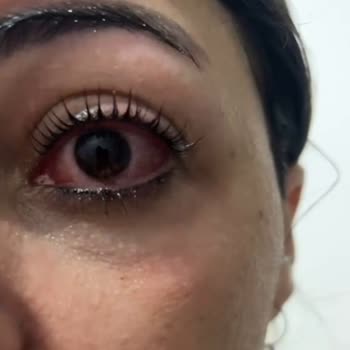 Kirpik Lifting Sonrası Ciddi Göz Enfeksiyonu Ve İhmalkar İşletme Yaklaşımı