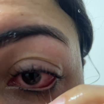 Kirpik Lifting Sonrası Ciddi Göz Enfeksiyonu Ve İhmalkar İşletme Yaklaşımı