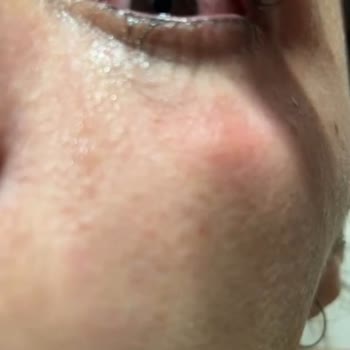 Kirpik Lifting Sonrası Ciddi Göz Enfeksiyonu Ve İhmalkar İşletme Yaklaşımı