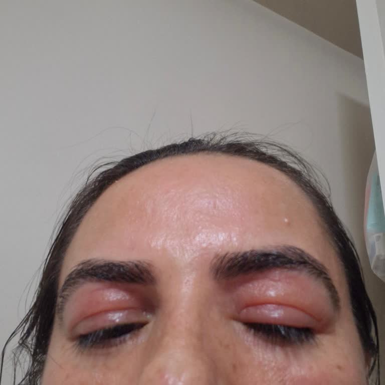 The Purest Solutions Göz Serumu Ve C Vitaminli Serum Cildimde Şiddetli Alerjiye Sebep Oldu