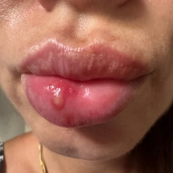 Tester Ruj Sonrası Yaşadığım Sağlık Sorunu Ve Hijyen Eksikliği