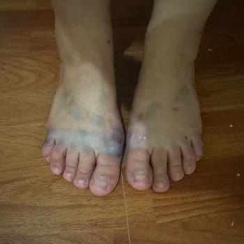 Greyder Sandalet İlk Kullanımda Ciddi Sorunlar Yaşattı