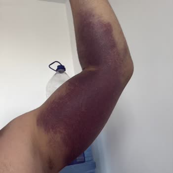 29 Mayıs Devlet Hastanesi Hatalı Serum Uygulaması Sonrası Kolum Zarar Gördü