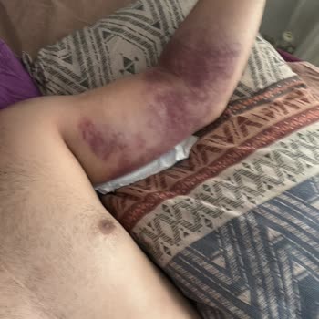 29 Mayıs Devlet Hastanesi Hatalı Serum Uygulaması Sonrası Kolum Zarar Gördü