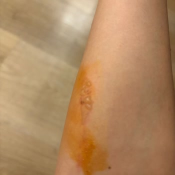 I Face Burn Injury from Loose Brush Head on My Dyson Airwrap and Got No Real Help