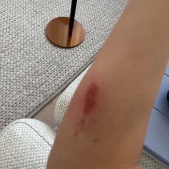 I Face Burn Injury from Loose Brush Head on My Dyson Airwrap and Got No Real Help