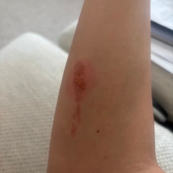 I Face Burn Injury from Loose Brush Head on My Dyson Airwrap and Got No Real Help
