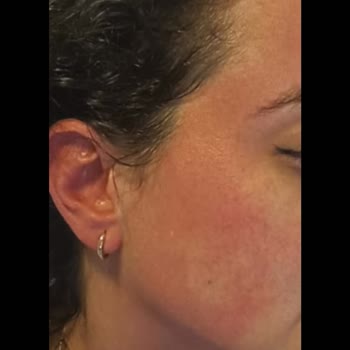 Şampuan İlk Kullanımda Ciltte Alerjik Reaksiyona Sebep Oldu