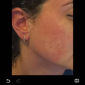 Şampuan İlk Kullanımda Ciltte Alerjik Reaksiyona Sebep Oldu