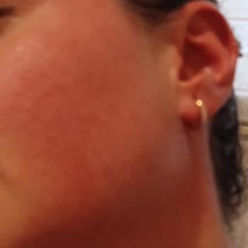 Şampuan İlk Kullanımda Ciltte Alerjik Reaksiyona Sebep Oldu