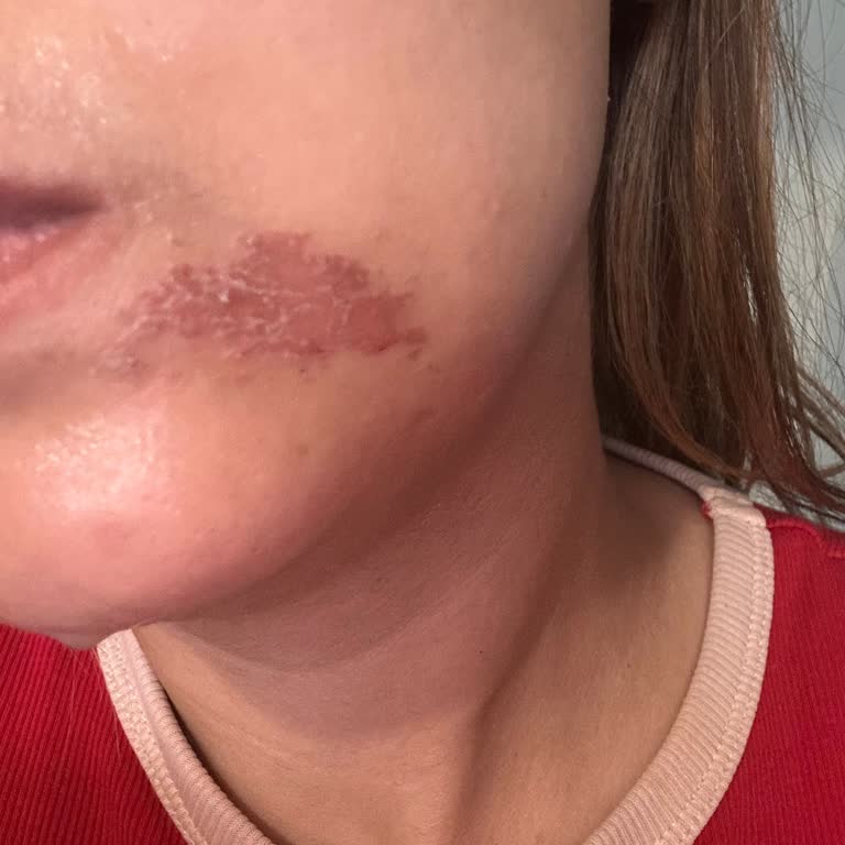 Yüz Ağdası Sonrası Ciddi Yanık Ve Yüksek Ücret Mağduriyeti