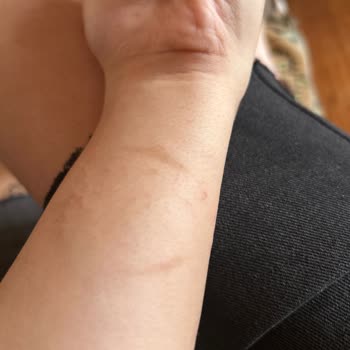 Trendyol Lazer Epilasyon Cihazı Yanık Oluşturdu!