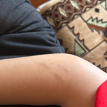 Trendyol Lazer Epilasyon Cihazı Yanık Oluşturdu!