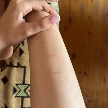 Trendyol Lazer Epilasyon Cihazı Yanık Oluşturdu!