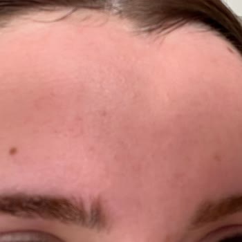 Yüz Temizleme Jeli Cildimi Tahriş Etti Ve Yanma Yaptı