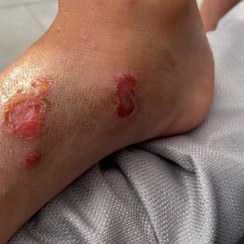 Otel Tatilinde Sağlık Sorunları Ve İlgisizlik Mağduriyeti